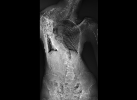 Escoliótico | Uma reflexão seis anos&nbsp;depois